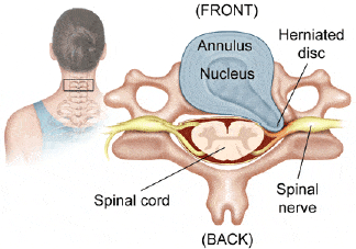 Neck Pain X-ray